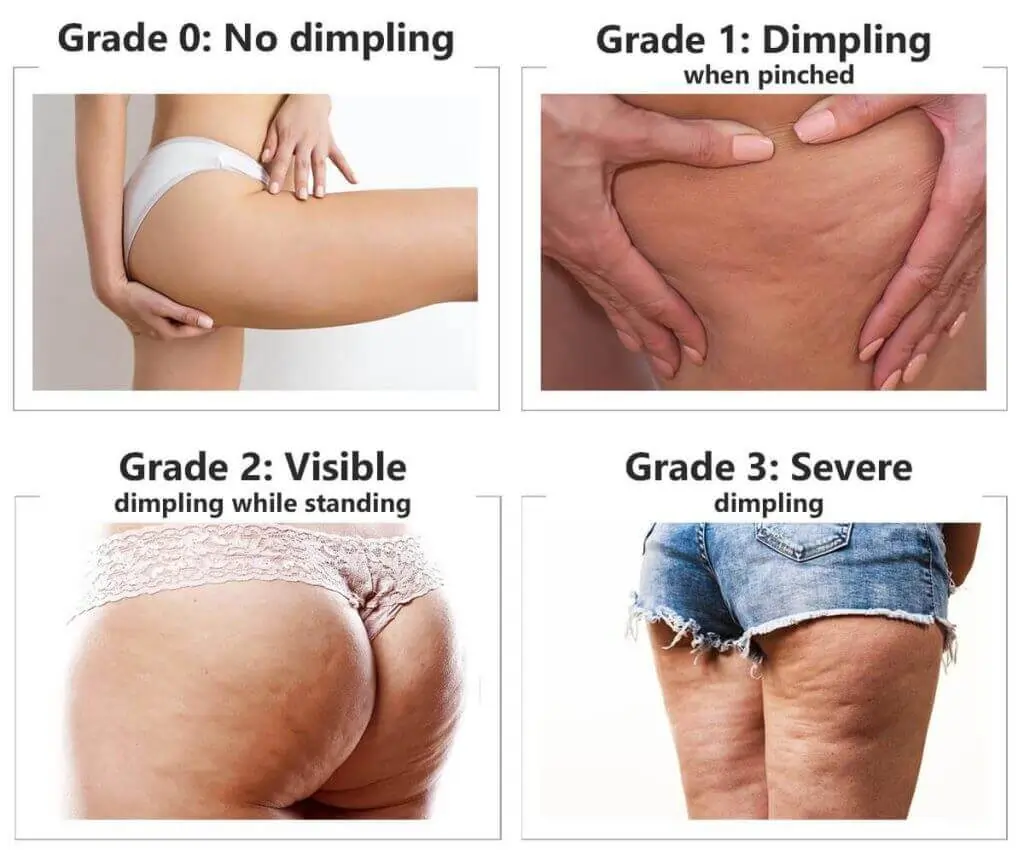 Representation of the stages of cellulite development Barton-le-Clay